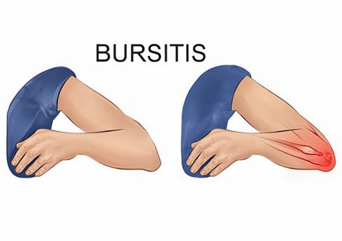 Bursit i armbågen är en inflammation i den vätskefyllda