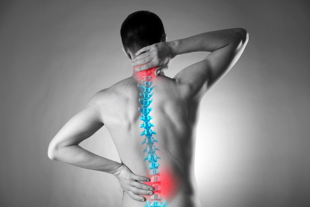 En nerv i kläm i ryggen innebär att en nerv komprimeras